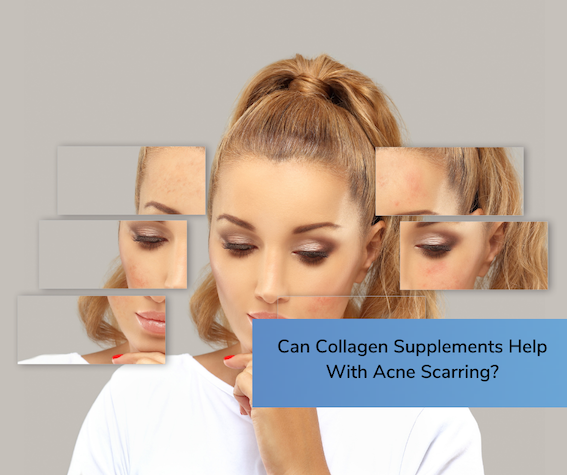Can Collagen Supplements Help With Acne Scarring?