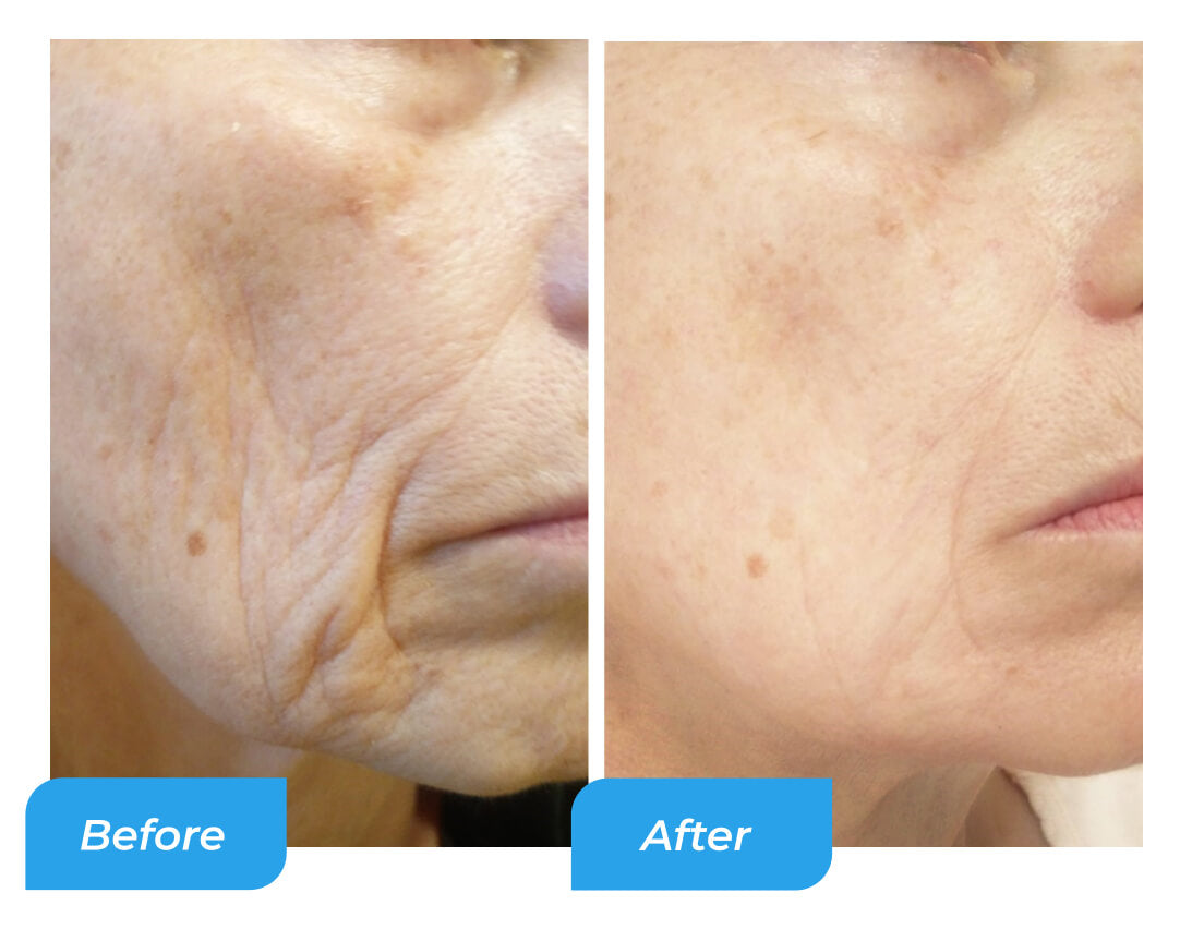Skin before and after using Reverse Life collagen